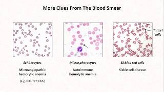 Anemia Lesson 4  Clues from the blood smear [upl. by Icak374]