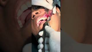 Special instrument and technique for upper 3rd molar surgery7044611705 thirdmolarsurgery [upl. by Samaria]