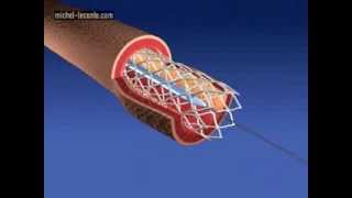 coronary artery stenting [upl. by Danae]