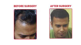 Transform Your Look with Hair Transplant PRP amp GFC  Hair Destination Experts [upl. by Kcirdahc]