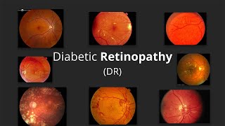 Doctor explains DIABETIC RETINOPATHY eye disease  STAGES SYMPTOMS PREVENTION AND TREATMENT [upl. by Anawad]