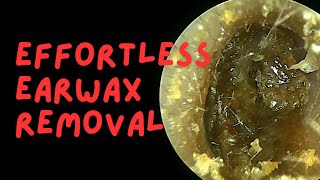 Effortless Earwax Removal [upl. by Gasper]