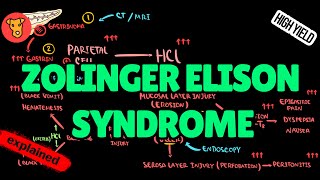 ZOLINGERELISON SYNDROME Pathogenesis Diagnosis Treatment [upl. by Faulkner308]