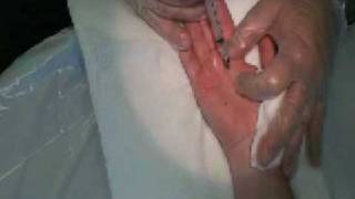 Palmar Hyperhidrosis Botox Procedure [upl. by Enitnatsnoc]