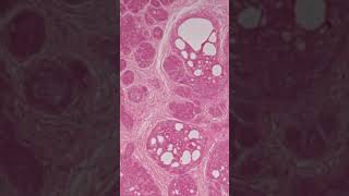 Trichoepithelioma  Pathology shorts [upl. by Adella]