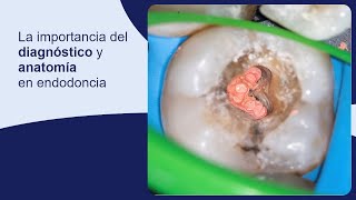 La importancia del diagnóstico y anatomía en endodoncia [upl. by Adnihc469]