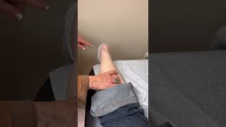 Diagnosing a Torn Achilles Tendon Tear [upl. by Afaw900]