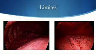 Localisation en réalité augmentée de nodules pulmonaires [upl. by Eitisahc704]