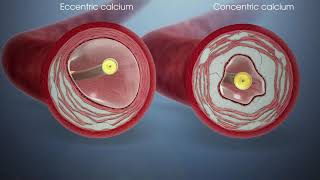 Shockwave Lithotripsy  Fortis Healthcare [upl. by Zetana]