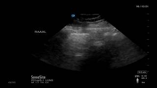 Lung Ultrasound Image Interpretation [upl. by Atem]