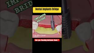 DENTAL IMPLANTS BRIDGE [upl. by Alikee]