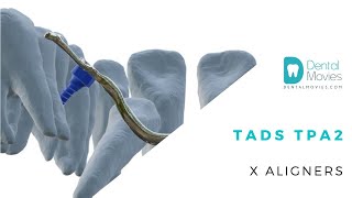 TADs Tpa2 x Aligners [upl. by Sirronal811]