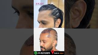 The Best Hair Transplant Results in India by Dr Suneet Soni at Medispa Hair Transplant Centre [upl. by Waxman]