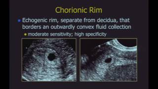 Ultrasound of Failed First Trimester Pregnancies and Ectopic Pregnancies [upl. by Yks]