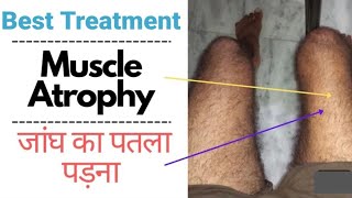 possibility in muscular dystrophy treatment with homeopathic medicines  muscular atrophy [upl. by Mei609]