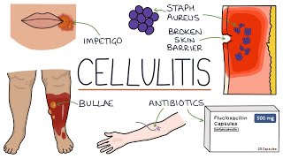 Understanding Cellulitis Skin and Soft Tissue Infections [upl. by Retsam]