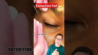 BLACKHEAD REMOVAL FAIL  Blackheads Around Eye shorts [upl. by Esmond]