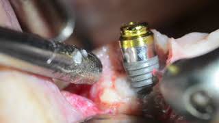 PeriImplantitis Management  Waterlase Laser Dentistry  Desai [upl. by Gasperoni154]