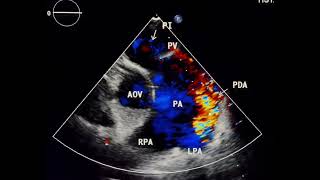 Patent ductus arteriosus to drahmadmirdamadisiomBJXyOSRxfgQGe5 [upl. by Vasiliu]