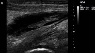 Bakers Cyst on ultrasound scan [upl. by Iggy]