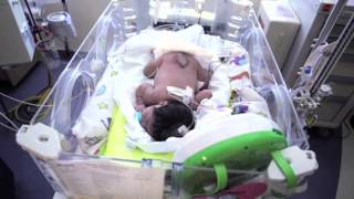 Newborn Baby with Spina Bifida Undergoes Multiple Surgeries [upl. by Duky]