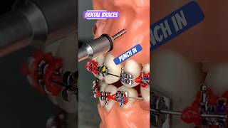 BRACES  Orthodontics PINS [upl. by Imak661]