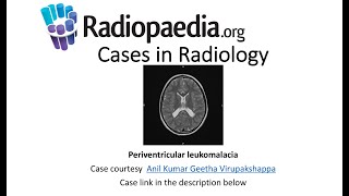 Periventricular leukomalacia Radiopaediaorg Cases in Radiology [upl. by Darbie]