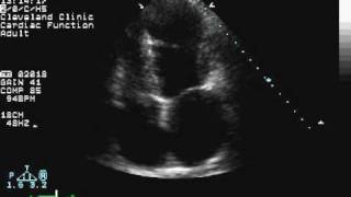 Cardiac Amyloidosis [upl. by Kelula]