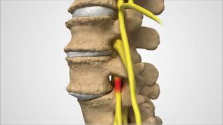 Anterior Lumbar Interbody Fusion [upl. by Rhu]