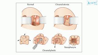 choanal atresia [upl. by Smoot]