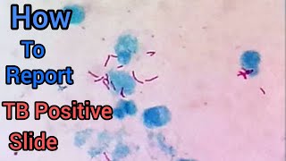 How To Report Positive Sputum Slide TB Positive Slide  ZN Stain  Mycobacterium Tuberculosis [upl. by Fusuy283]