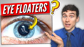 3 Must Know Facts About EYE Floaters [upl. by Carma]