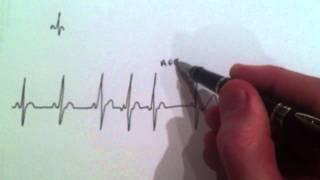 A Cardiologist explains Atrial Ectopic beats with an ECG annotation [upl. by Enaywd576]