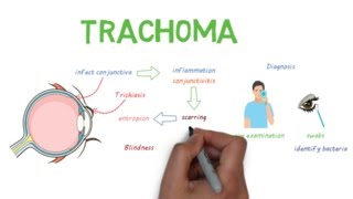 Trachoma  a devastating infectious eye disease [upl. by Yessej]