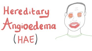 Hereditary Angioedema HAE [upl. by Earehs]