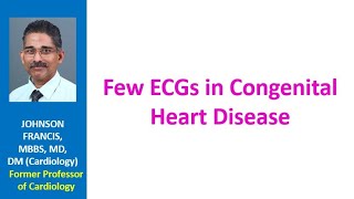 Few ECGs in Congenital Heart Disease [upl. by Berkly404]