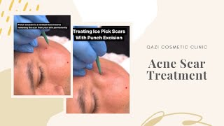 Treating Acne Scars With Punch Excision [upl. by Kinsley]