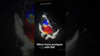 Mitral regurgitation echocardiography echocardiographer itral regurgitation [upl. by Wall]