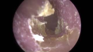 Endoscopic Treatment of Otitis Externa with Otorrhea  346 [upl. by Bella406]