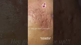 Effective method for removing deep acne scars [upl. by Camilia]