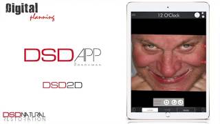 Digital Smile Design using the Official DSD App [upl. by Hengel]