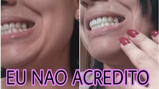 COMO COLOCAR RESINA LIQUIDA DA SHOPEE DENTE PROVISÓRIOPRIHELOISA httpssshopeecombr1qHE9I6hV5 [upl. by Reckford147]