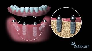 Blue Sky Bio Multi Unit Abutment [upl. by Quartana959]