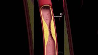 Arteriosclerosis means “hardening of the arteries” [upl. by Reste668]