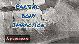 Mesioangular Partial Bony Wisdom Tooth Extraction Video [upl. by Sacci]