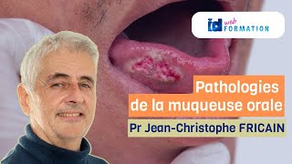 Formation Elearning DPC  Pathologies de la muqueuse orale [upl. by Jasun]