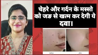 How to remove warts on face and neck।। [upl. by Dane453]