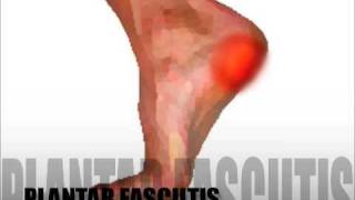 Plantar Fasciitis Diagnosis amp Treatment [upl. by Torrence107]