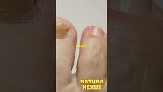 Is It Safe to Pop a Blister The Shocking Facts You Need to Know [upl. by Acsisnarf]