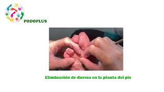 Tratamiento de la hiperqueratosis o clavo en la planta del pie [upl. by Anse]